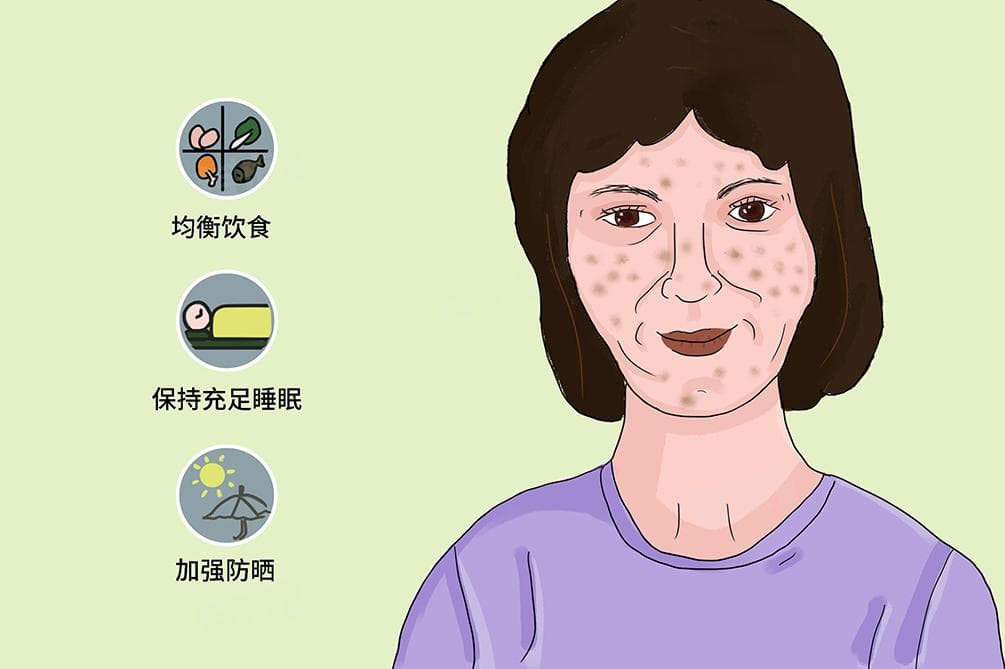 妊娠斑怎么去除最有效