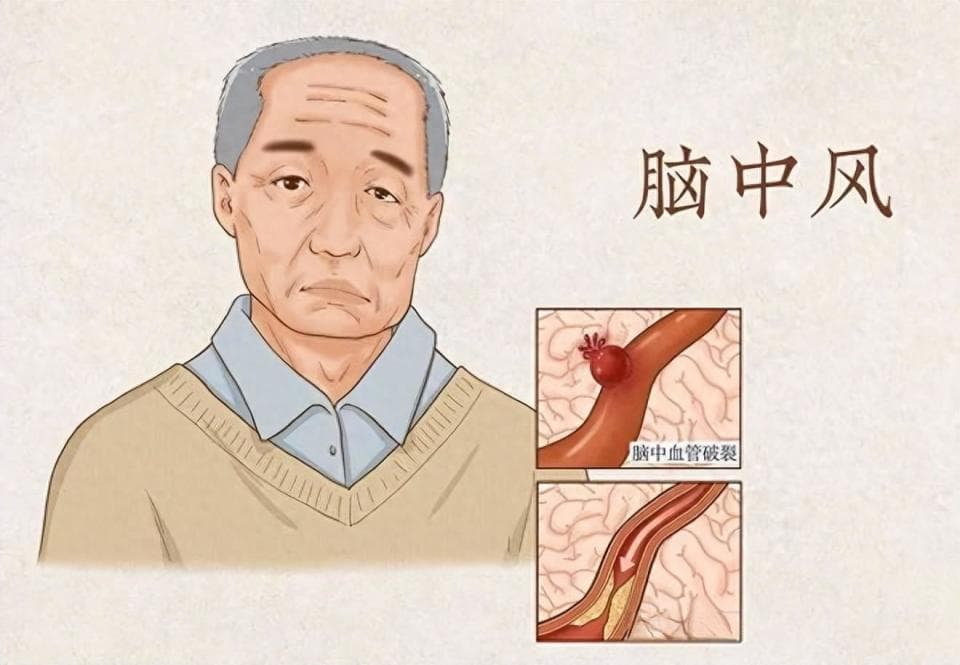 出现这些症状，可能是突发脑中风！正确做出判断，立即就医！