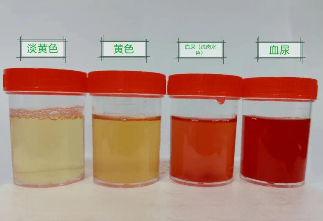 辩尿识健康！血尿 = 肾癌？可能还跟这些因素有关