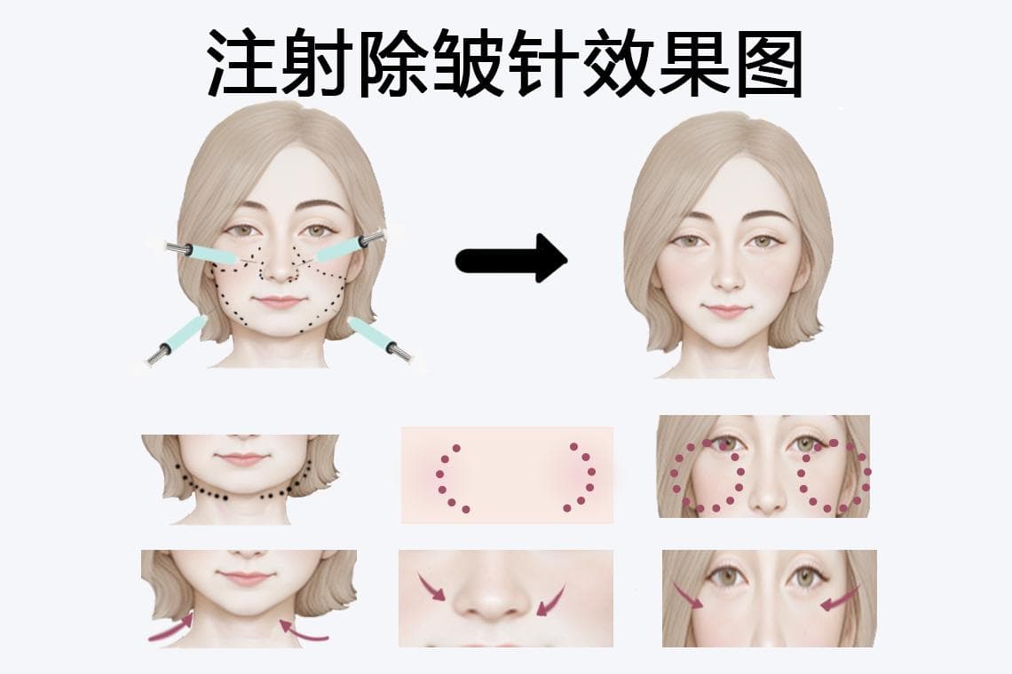 打除皱针后的注意事项有哪些