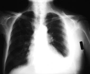 胸腔积液X线、超声、CT检测，一文总结！│临床必备