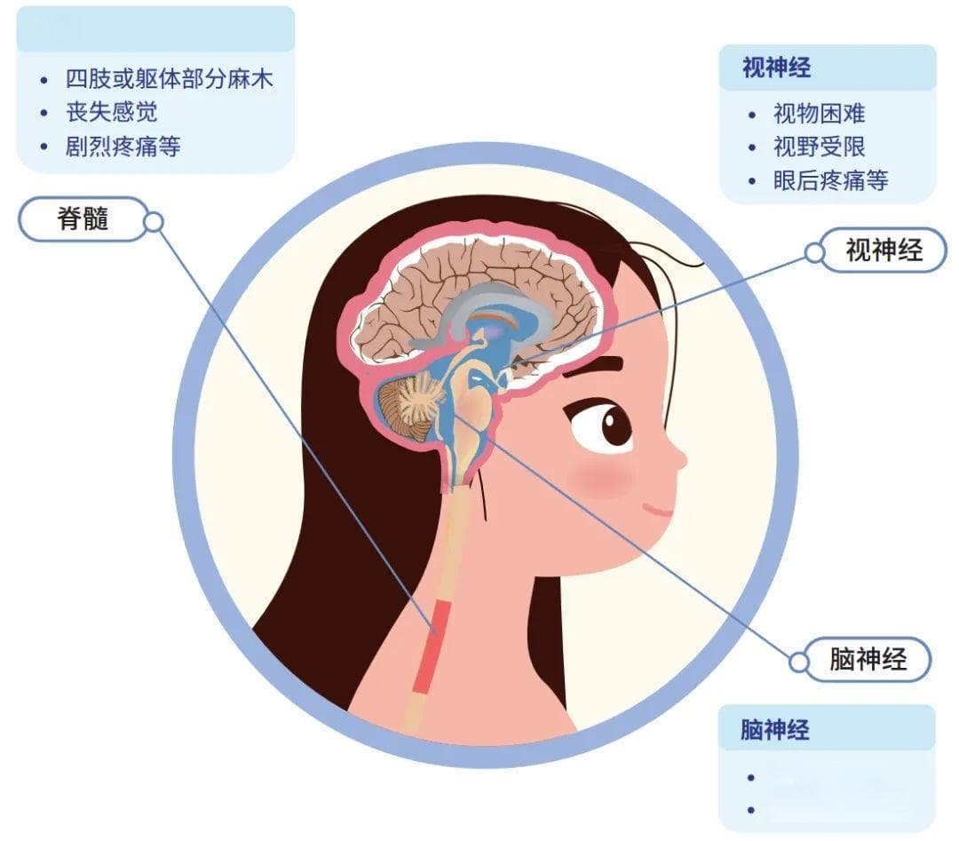 【医学】视神经脊髓炎谱系疾病(NMOSD)：从诊断到治疗的全面解析