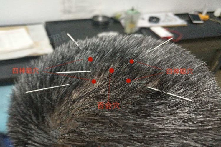 头部针灸后多久可以洗头