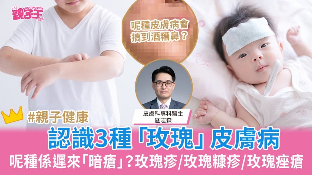 玫瑰痤疮是迟来的“暗疮”？认识3种“玫瑰”皮肤病：玫瑰疹/玫瑰糠疹/玫瑰痤疮