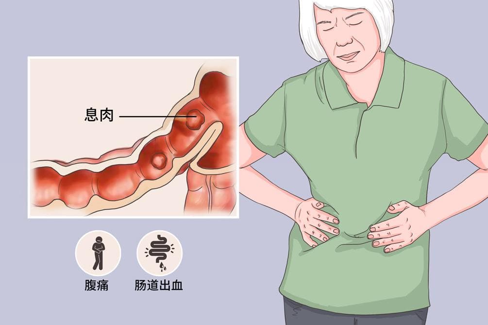 肠息肉会影响消化吸收吗