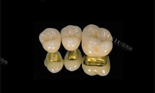 后牙做牙冠什么材料好性价比高？咬合力/使用感受/美观性等多角度分析不同材料优势