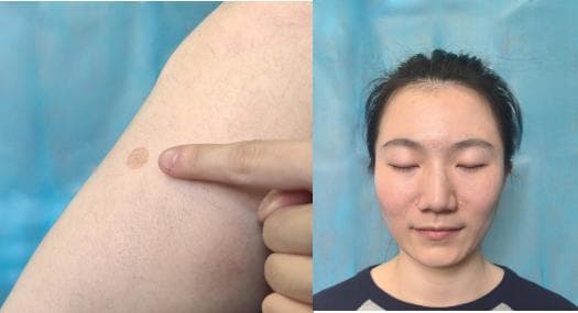 鼻炎还可以这么治！什么是“揿针”治疗？