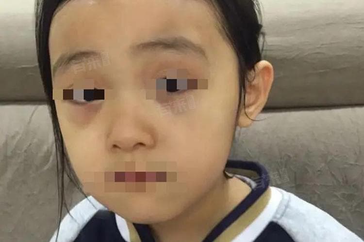 孩子有黑眼圈怎么消除