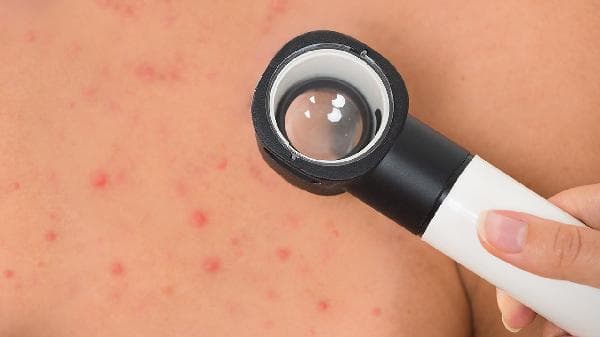 过敏性紫癜：病因、治疗与预防全解析