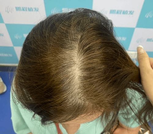 女性脱发怎么办？这三种治疗方法了解一下！
