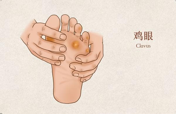 脚上长了鸡眼，能不能自己在家处理？