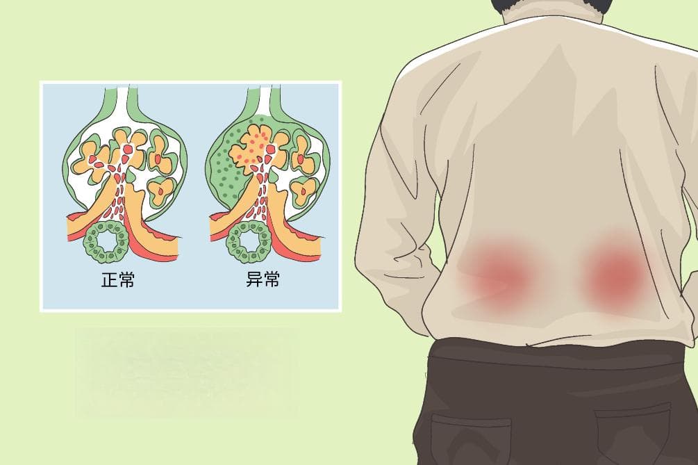 肾小球硬化：病因、症状、诊断与治疗全解析