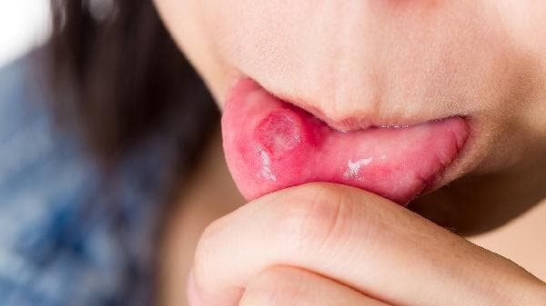 冰硼散口腔溃疡正确使用方法