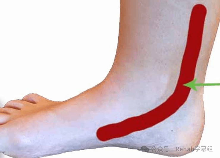 胫骨后肌肌腱病的评估与诊断