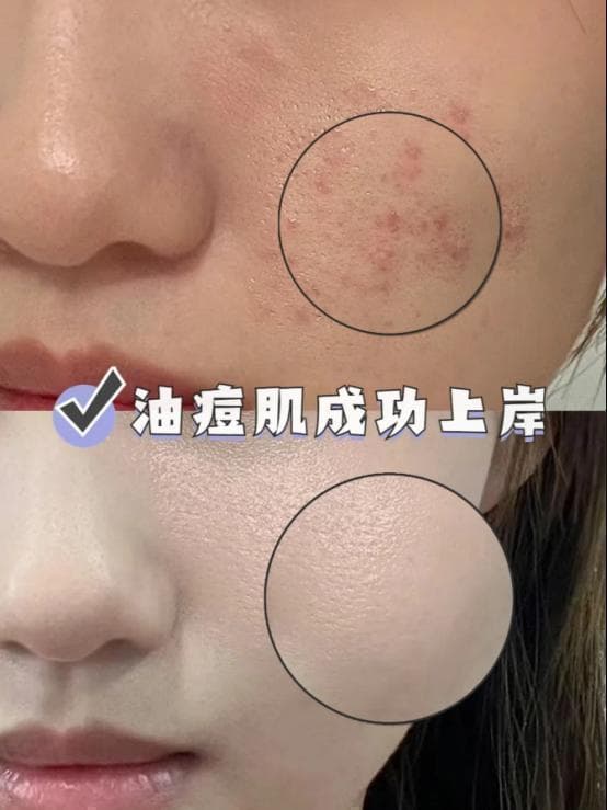 青少年长痘痘的影响远不止脸面，心理压力也需要及时处理，消除自卑的隐患