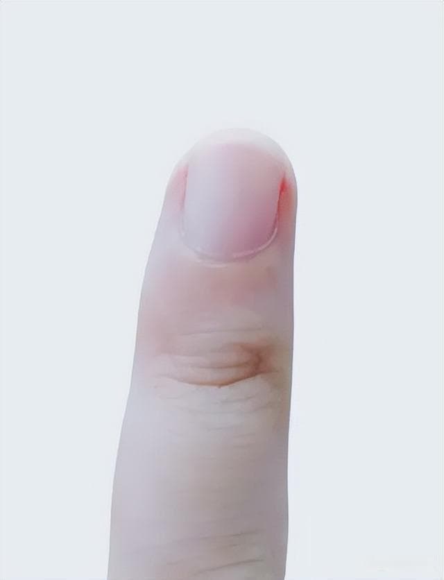 指甲外观变化全解析：哪些是正常，哪些需警惕