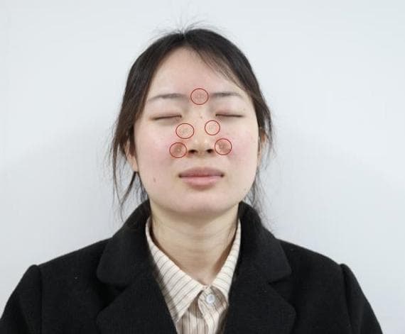 体质竟是引发过敏性鼻炎的重要因素 中医药疗法半年帮助千名患者消除症状