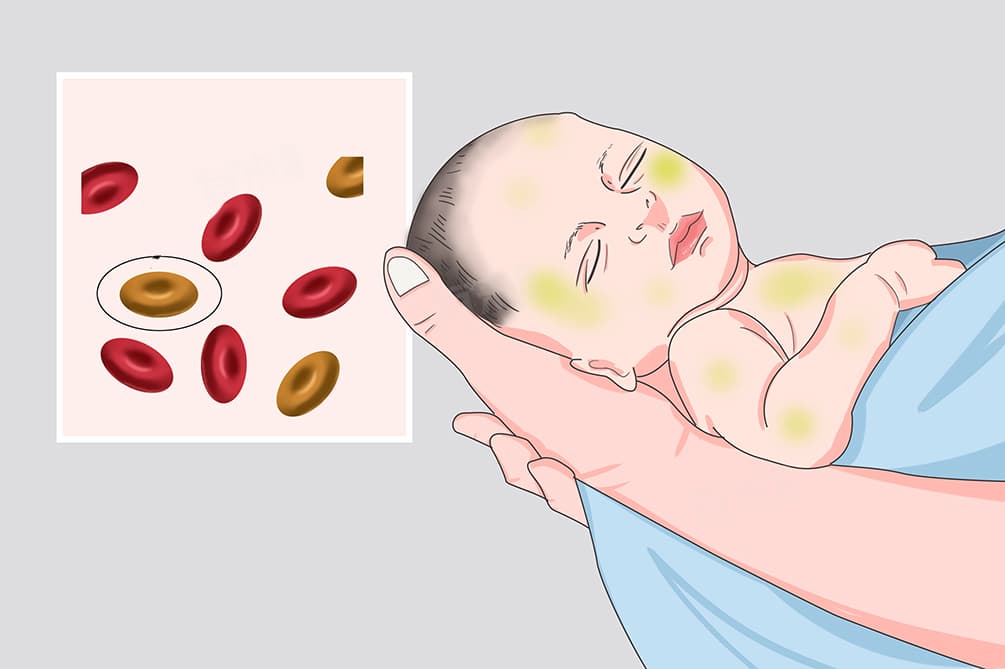 小孩黄疸检测方法