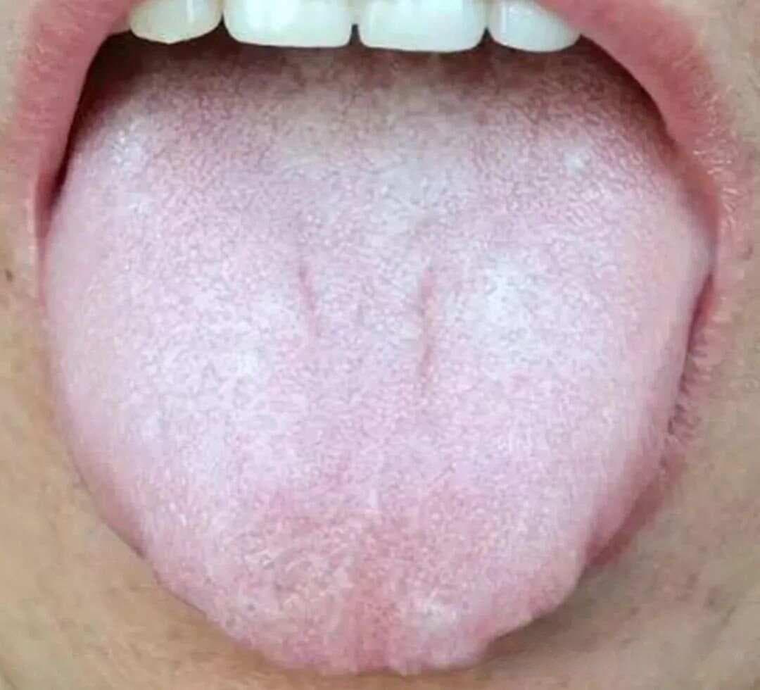 自我看舌，预知末病（常见36种舌象之一）