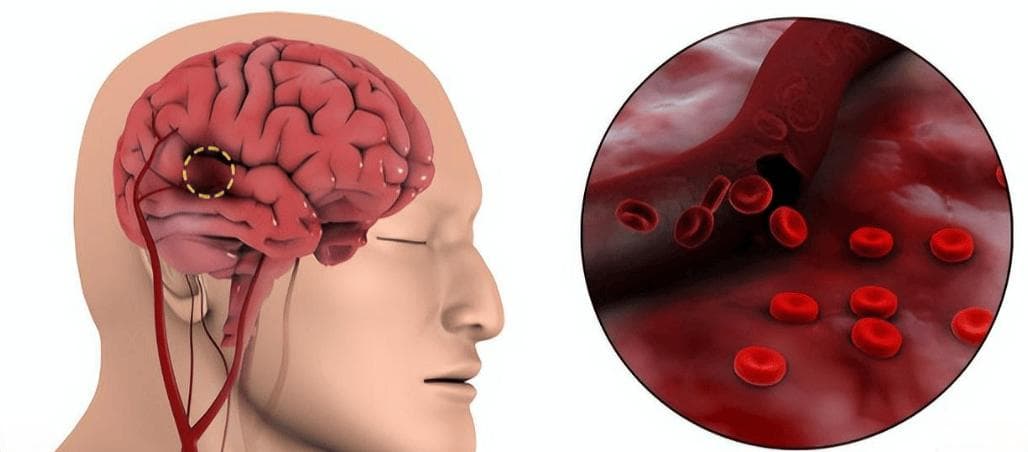 一文理清系列：昏迷患者的评估及处置