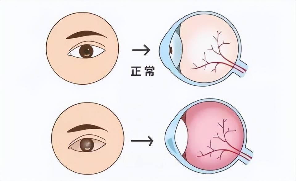 45岁以后青光眼发病率高，出现5类症状及时就医，早发现，早治疗
