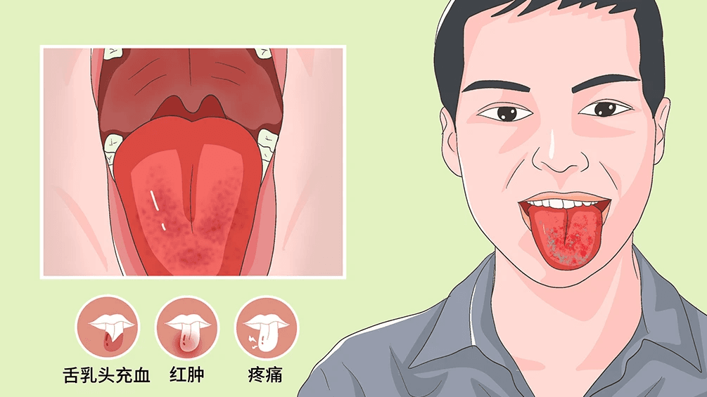 舌炎都有什么症状？这些情况不容忽视