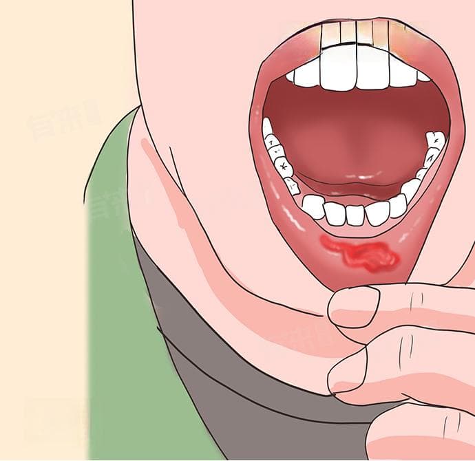 嘴巴里侧忽然一个大血泡怎么办？原因及处理方法全解析