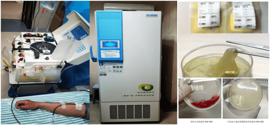 甘肃省中医院：为什么选择PRP？——富血小板血浆（PRP）的临床应用