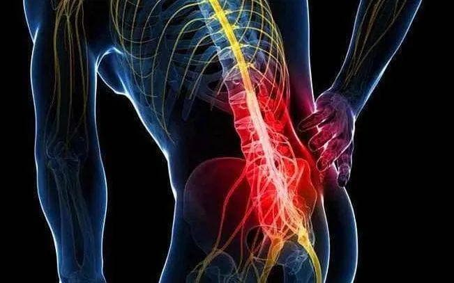 硬膜外注射糖皮质激素治疗腰骶神经根性疼痛