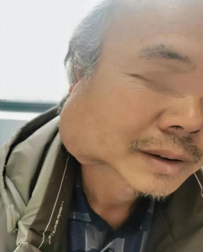 手术堪比整容！专家巧切巨型腮腺肿瘤，助46岁男子重获“新颜”