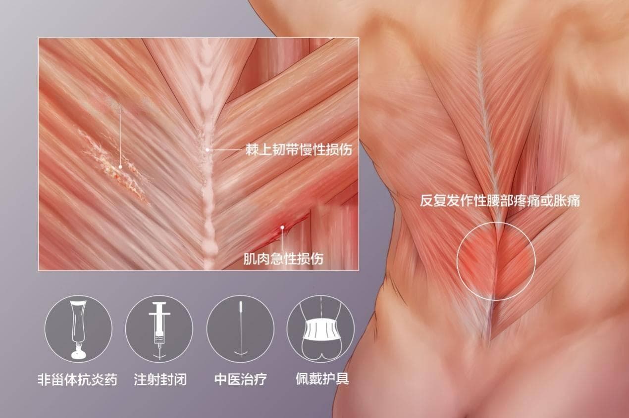 15个小技巧帮你缓解腰痛腰酸