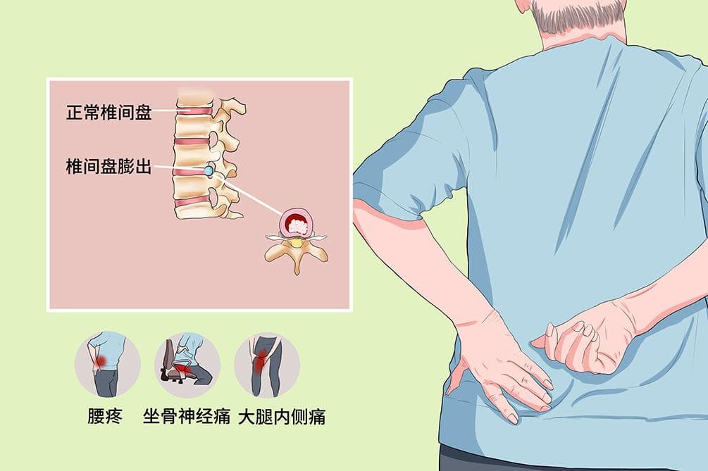 腰椎间盘膨出患者每天需要卧床多久？一文详解不同病情下的休息时间