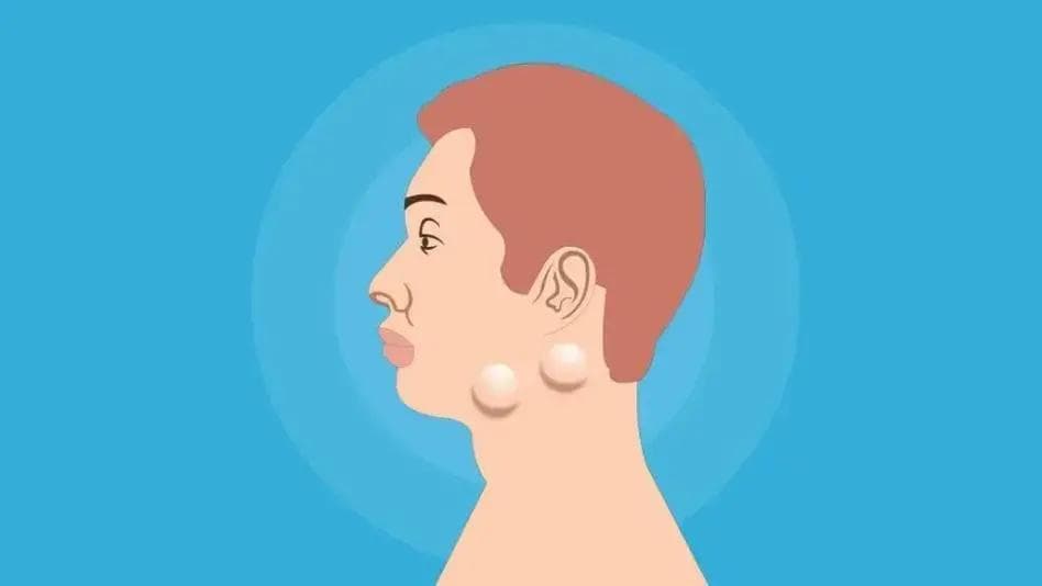 淋巴结肿大怎么办？是这6原因引起的！4个治疗方法，守护你健康