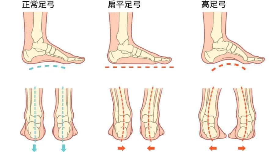 关于扁平足的那些事儿：到底是“脚平”还是“病”呢？