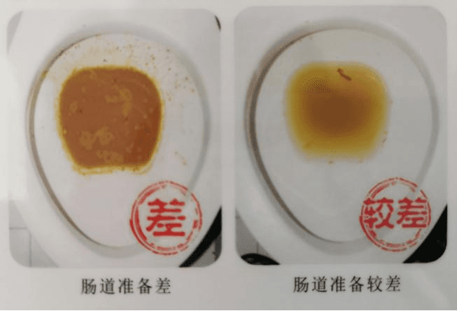 入门级科普，轻松看懂胃肠镜检查