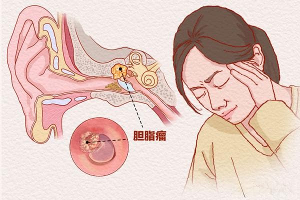 中耳胆脂瘤似瘤非瘤 重庆松山医院：切莫忽视早手术