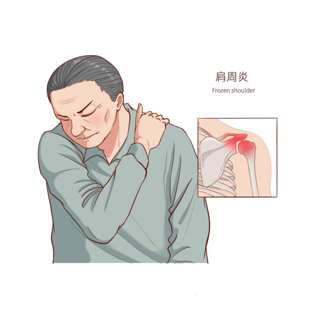 如何判断自己是否患有肩周炎?