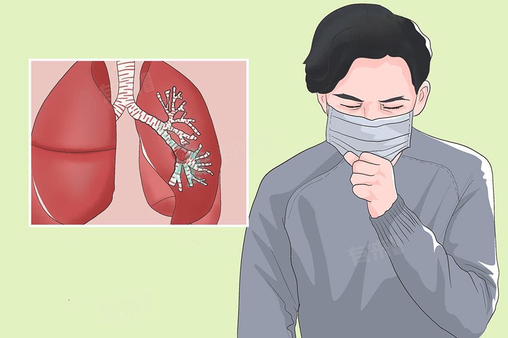 小细胞肺癌最佳治疗方案