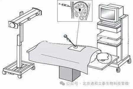 肿瘤消融技术：微创治疗肿瘤的“针”尖艺术