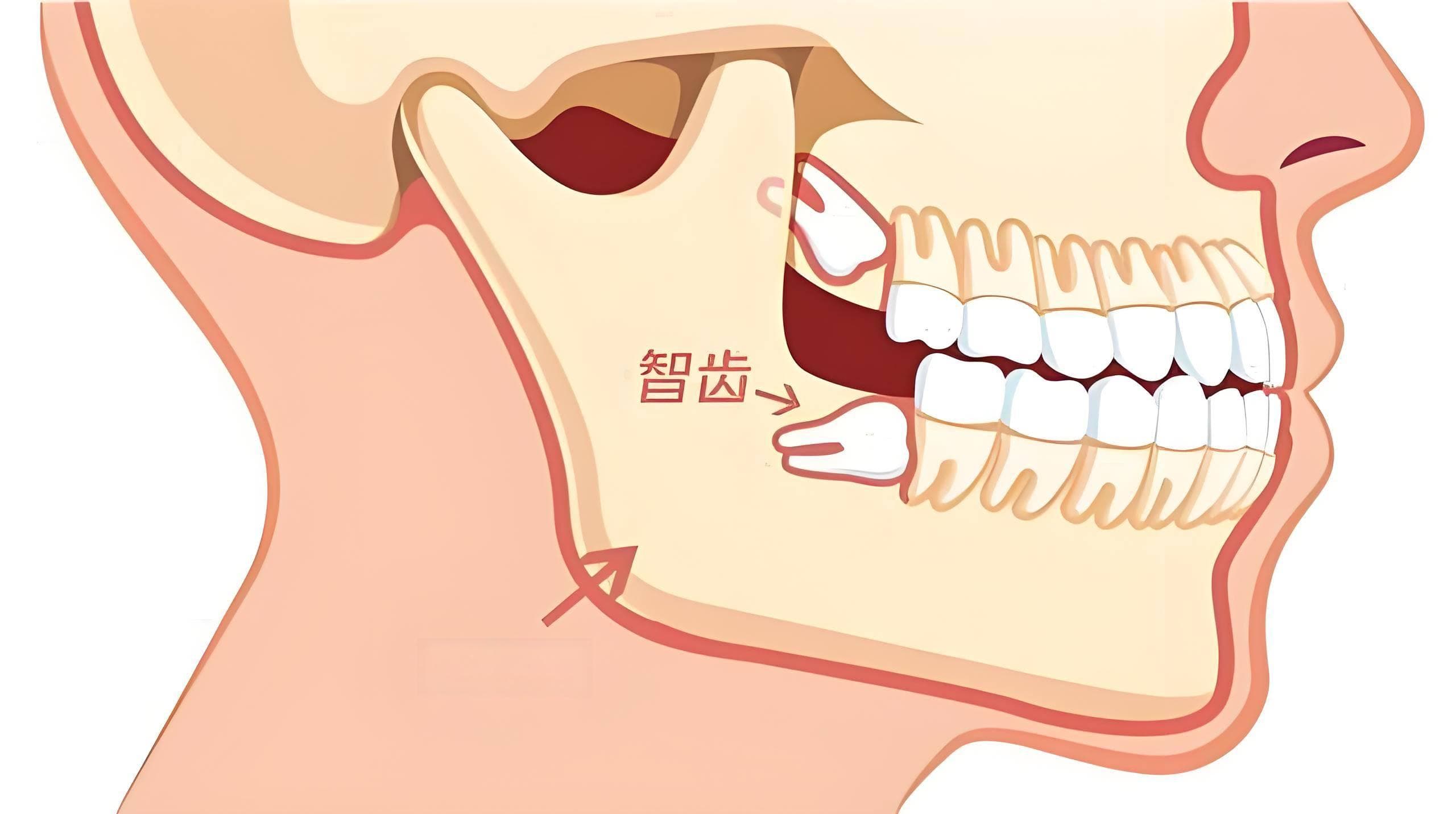 为什么有的人智齿长的正常，有的人智齿就长歪了？