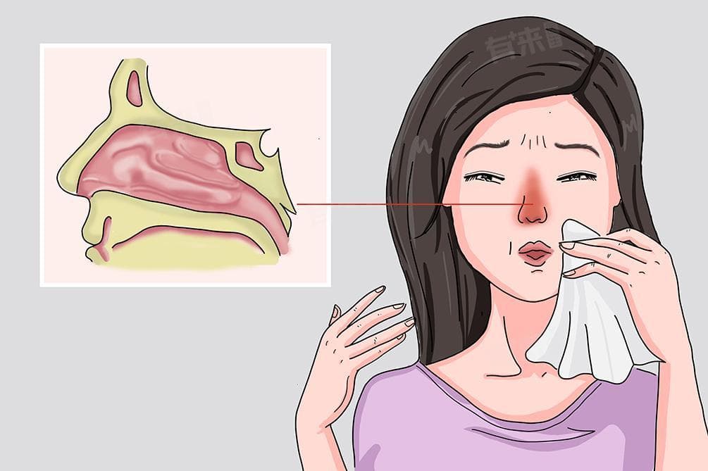 鼻腔镜检查和鼻CT检查的区别