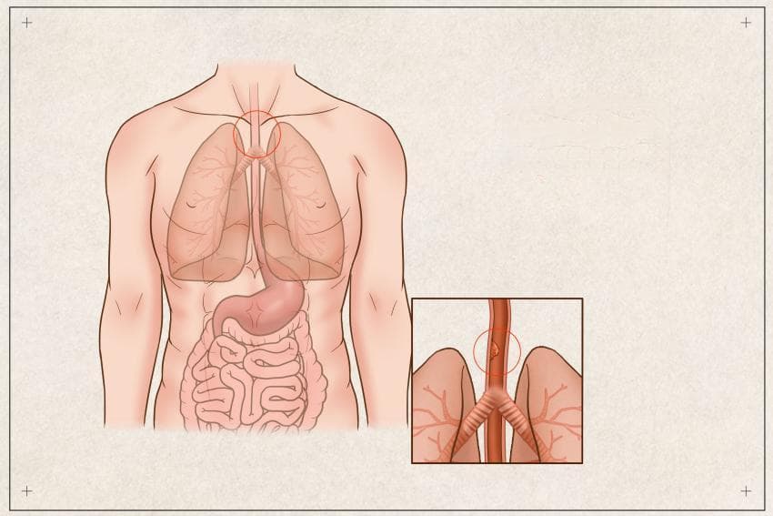 食管癌患者的营养“红绿灯”：营养风险评估与管理