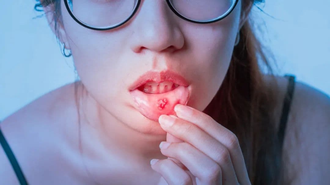 反复口腔溃疡，可能不是单纯的“上火”！这种病要小心！