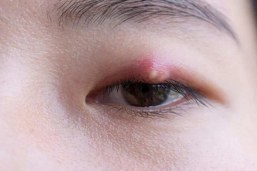 孩子长了“针眼”怎么办？这些处理方法你要知道