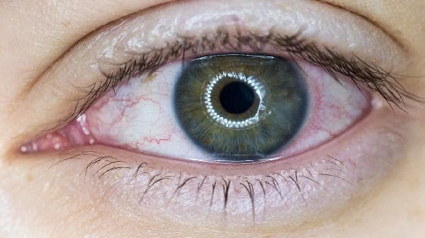 春季结膜炎怎么办？5种常用滴眼液缓解症状，医生推荐用法全解析