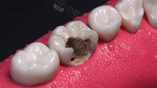 龋齿如何让它停止腐蚀?牙医：蛀牙治疗方法很多但不包含认真刷牙!