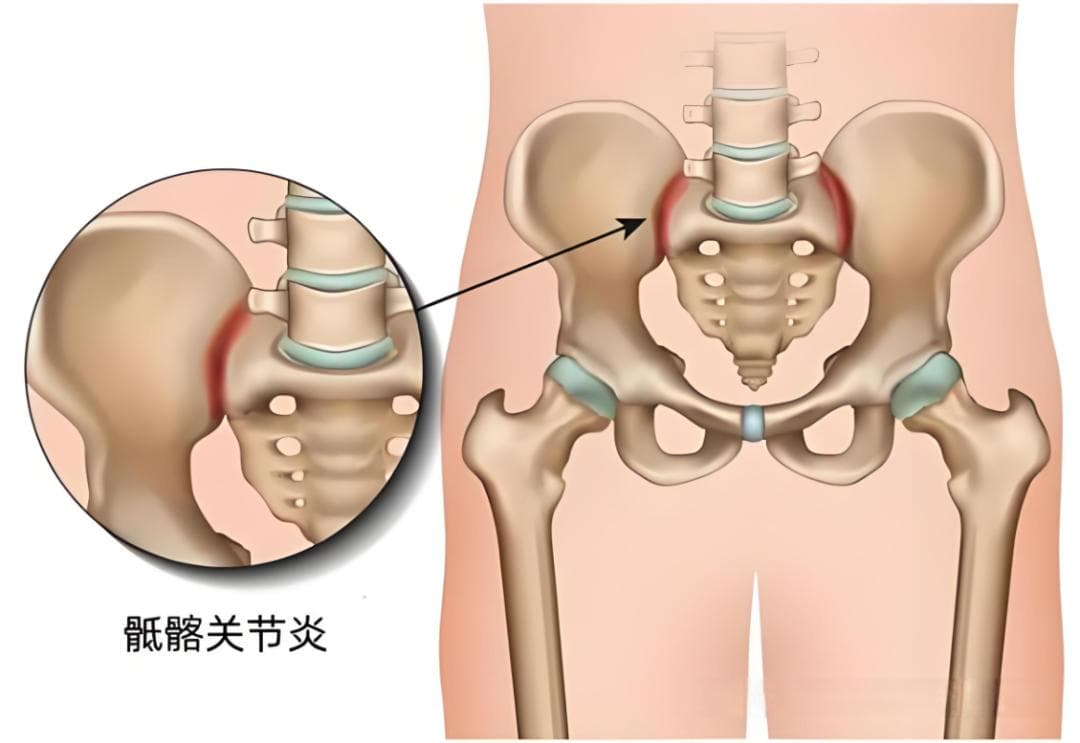 臀部疼痛是咋回事？重点关注这 7 种病！