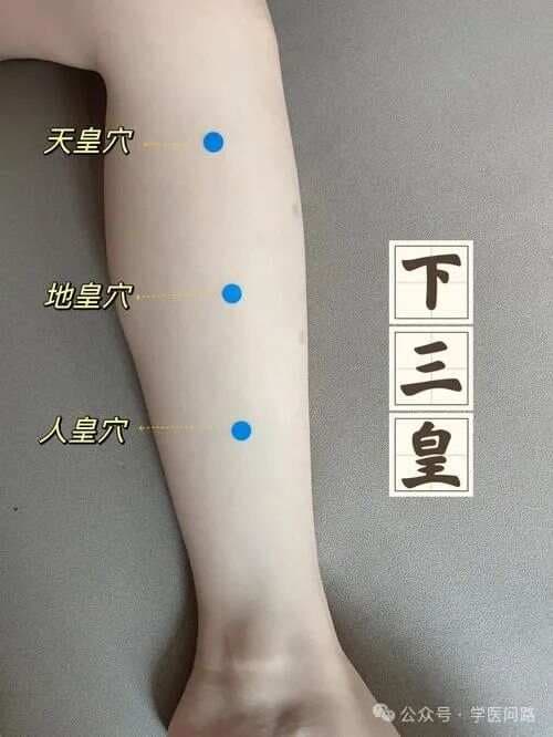 糖尿病三针：天皇、肾关、水相详解