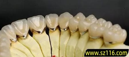 钴铬合金烤瓷牙耐磨吗？与钛合金烤瓷牙哪个好？