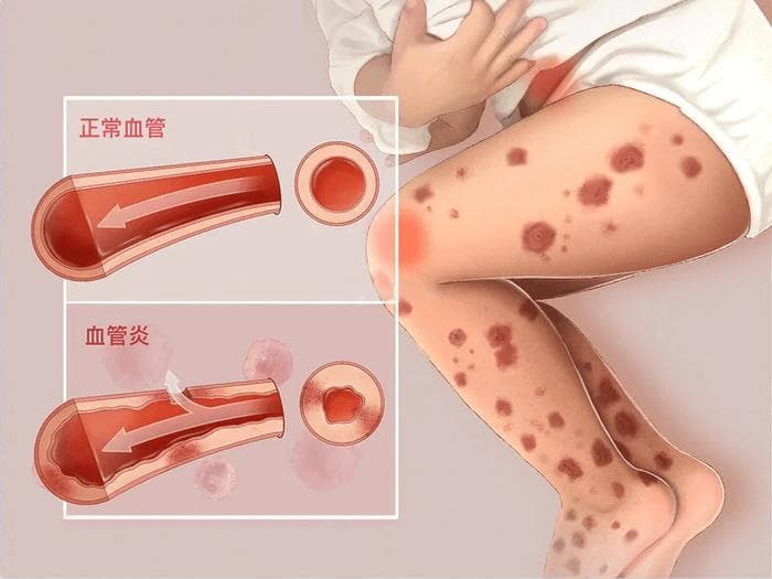 揭秘过敏性紫癜：从病因到防治的全面解析